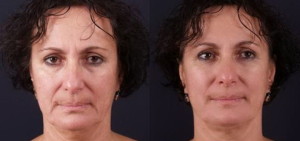 exilis-before-and-after-face2